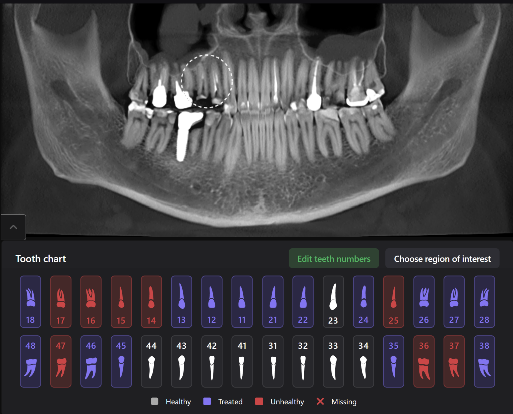 Case study - orthodontic treatment plan for tooth extrusion 1