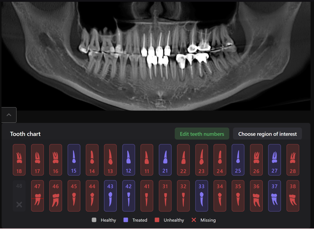 Total prosthetic rehabilitation - case study 1