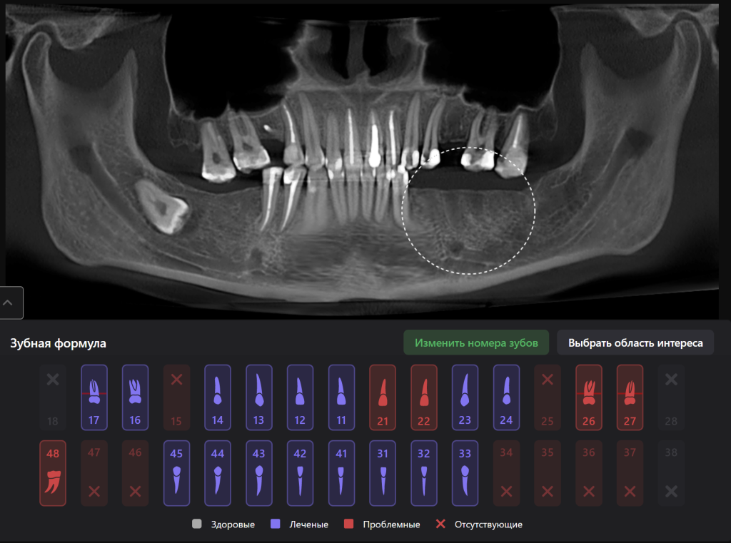 Case study - Reconstruction of the alveolar ridge using Diagnocat AI 1