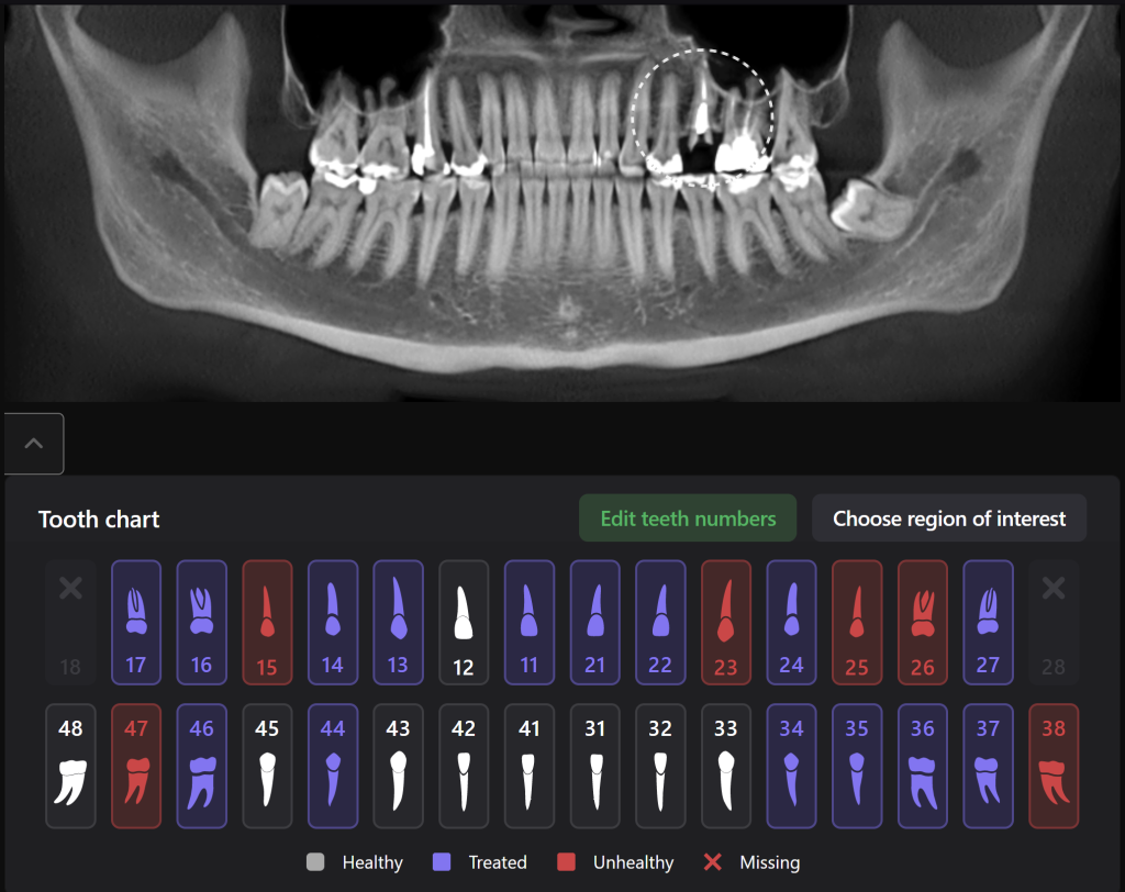 Case study: Implant planning for missing tooth 25 (universal 13) 1