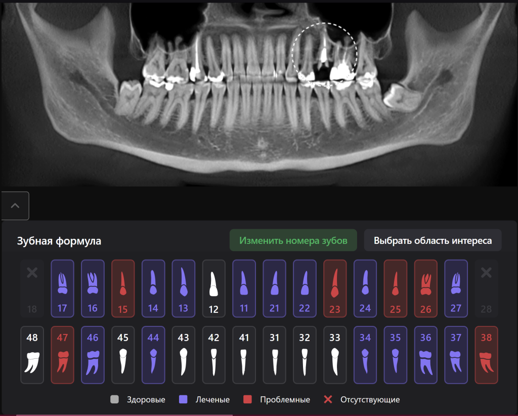 Случай из практики - планирование одномоментной имплантации с помощью ИИ Diagnocat 1