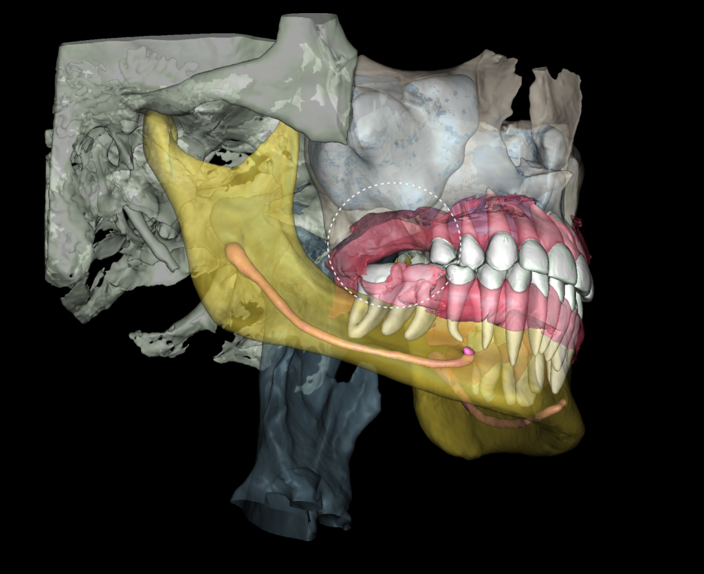 Implant treatment planning 3