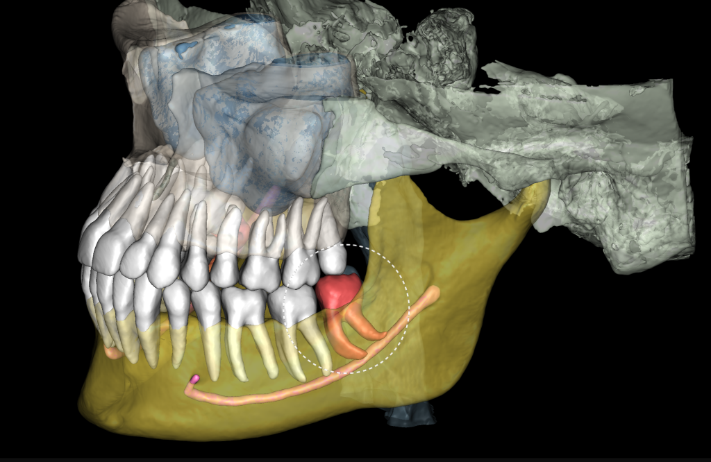 Case study - Treatment plan for atraumatic extractions 3