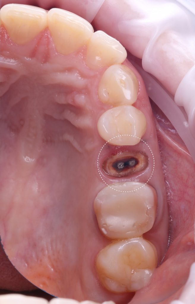 Case study: Implant planning for missing tooth 25 (universal 13) 3