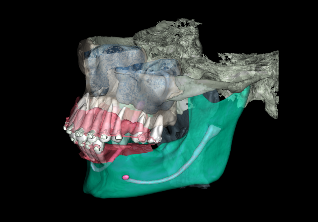 Case study - Reconstruction of the alveolar ridge using Diagnocat AI 3