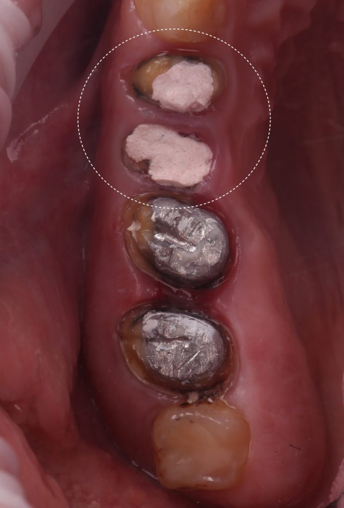 Case study - orthodontic treatment plan for tooth extrusion 3
