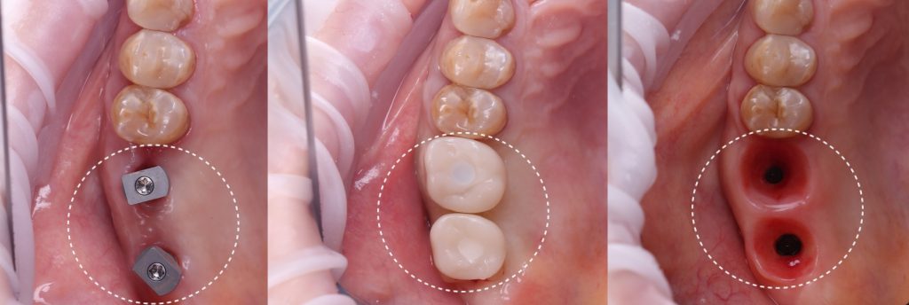 Implant treatment planning 5