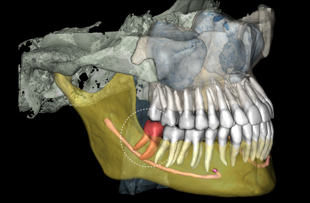 Case study - Treatment plan for atraumatic extractions 5
