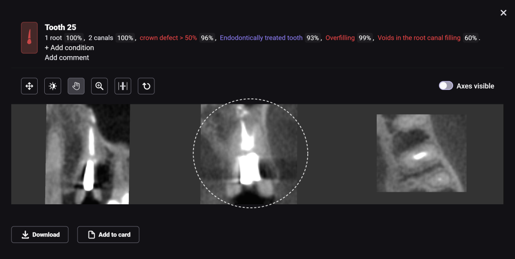 Case study: Implant planning for missing tooth 25 (universal 13) 5