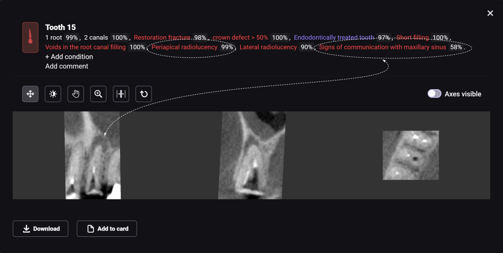 Case study - orthodontic treatment plan for tooth extrusion 7