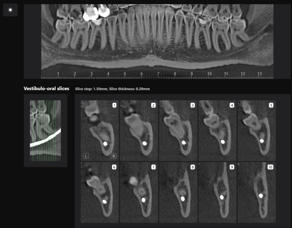 Case study - Treatment plan for atraumatic extractions 7