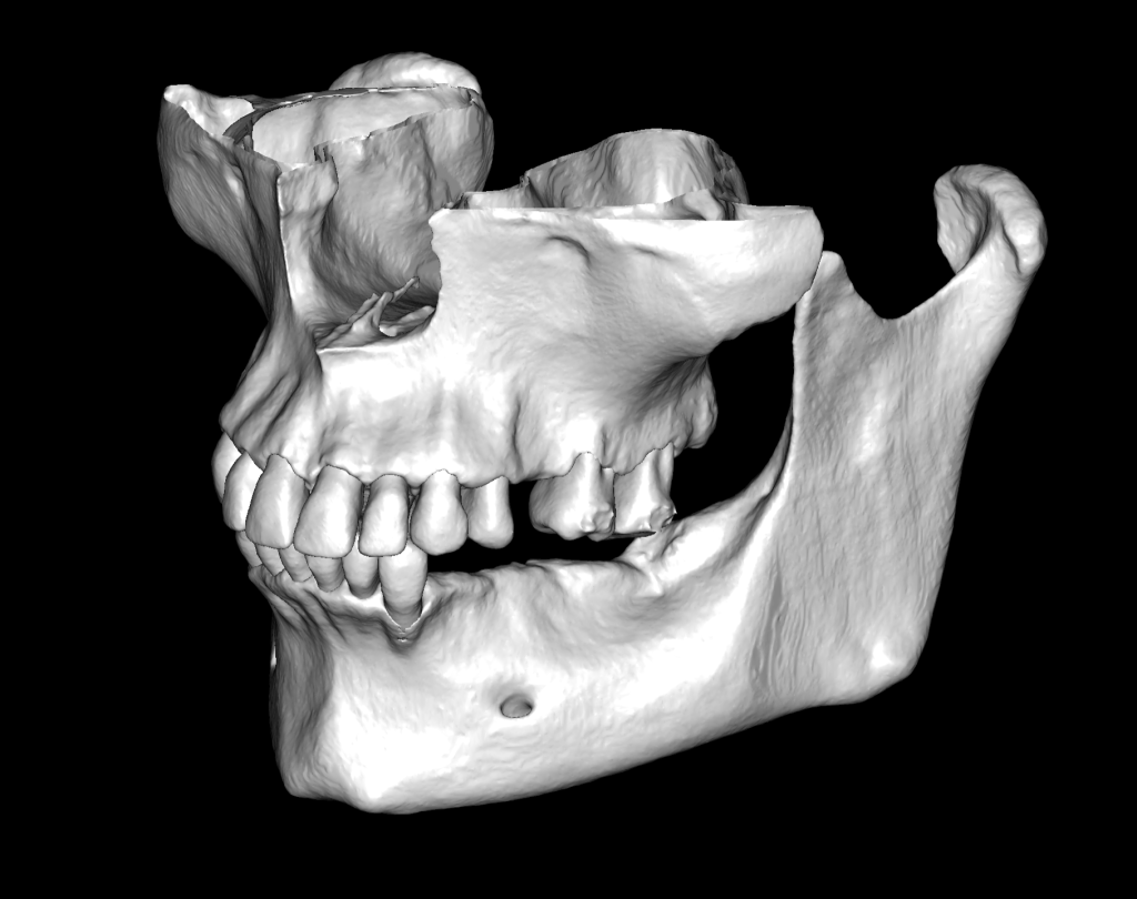 Case study - Reconstruction of the alveolar ridge using Diagnocat AI 7