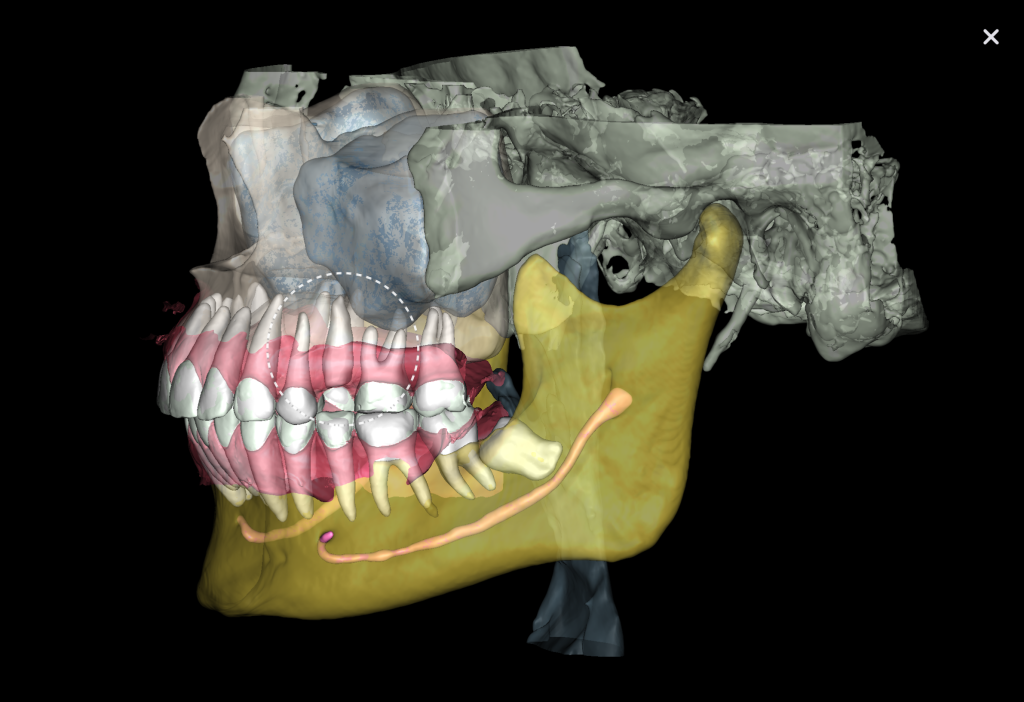 Case study: Implant planning for missing tooth 25 (universal 13) 7