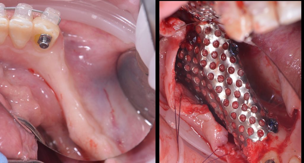 Case study - Reconstruction of the alveolar ridge using Diagnocat AI 9