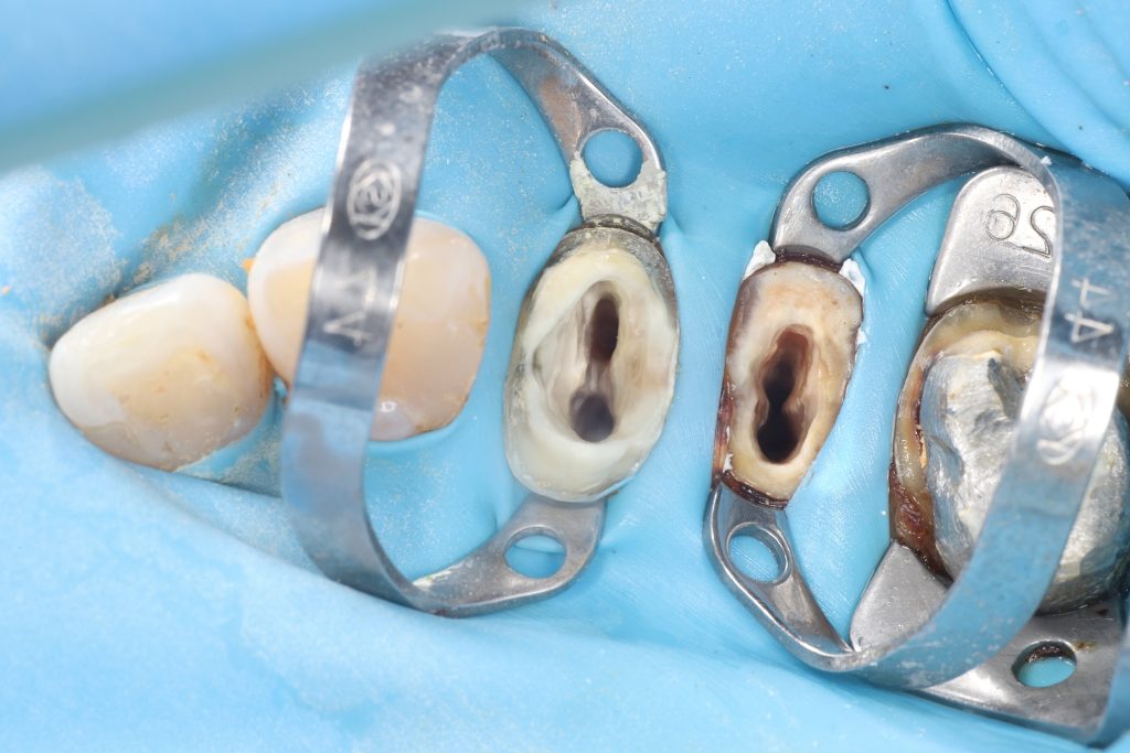 Case study - orthodontic treatment plan for tooth extrusion 9