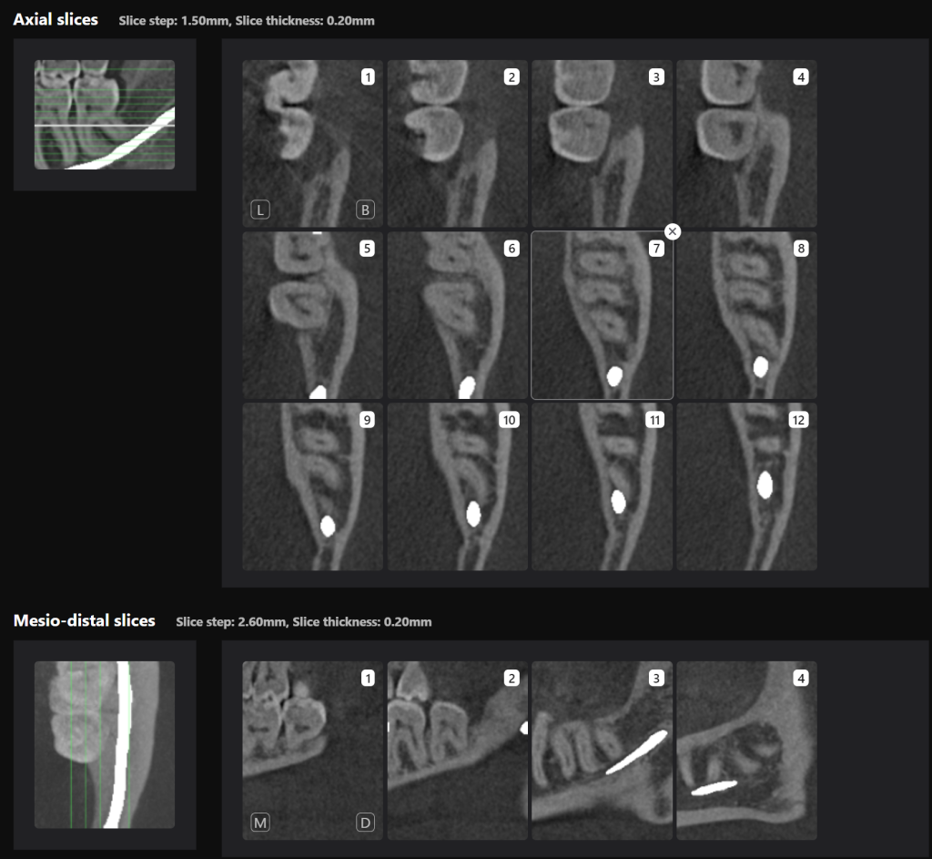 Case study - Treatment plan for atraumatic extractions 9