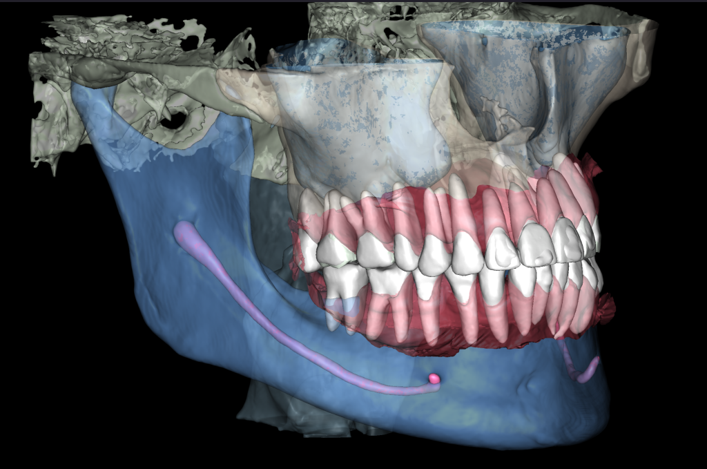 Total prosthetic rehabilitation - case study 11
