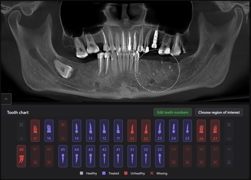Case study - Reconstruction of the alveolar ridge using Diagnocat AI 11