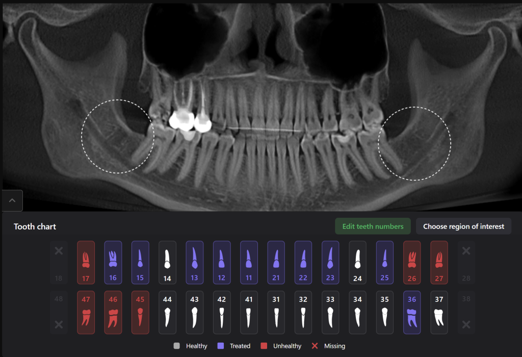 Case study - Treatment plan for atraumatic extractions 11