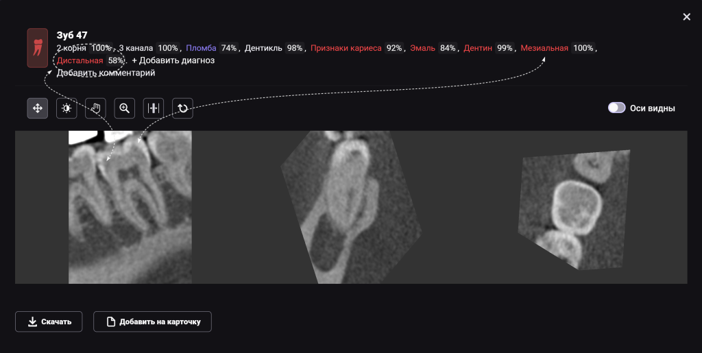 Рентгенологический отчет Diagnocat - особые возможности 11