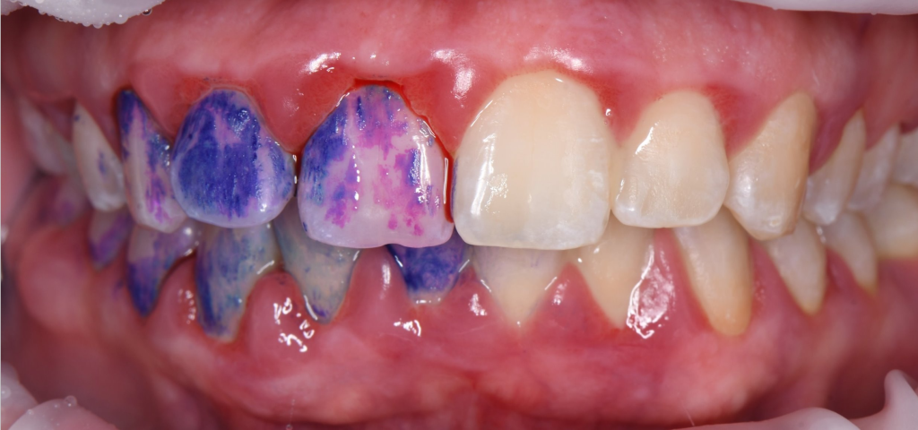 Treatment of severe periodontal disease 1