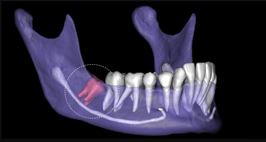 Planning third molar extraction with Diagnocat 1