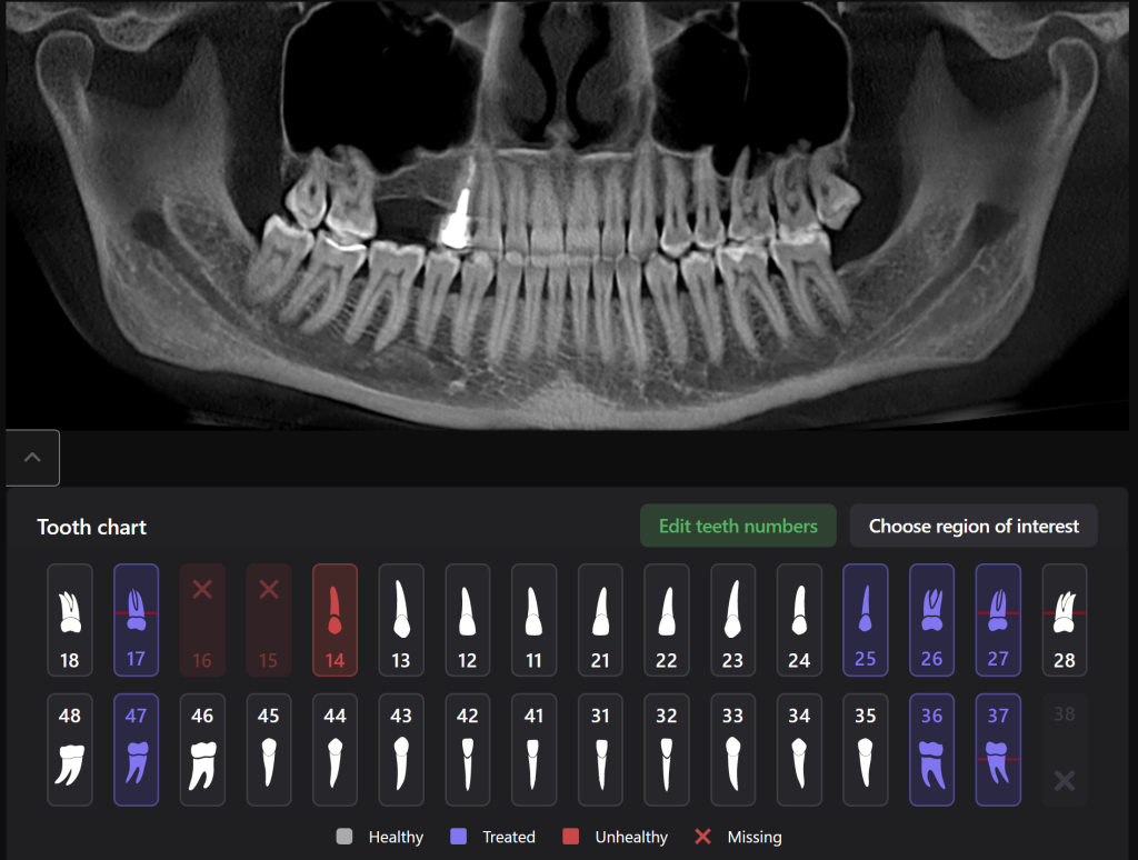 Planning guided implant surgery with Diagnocat 1