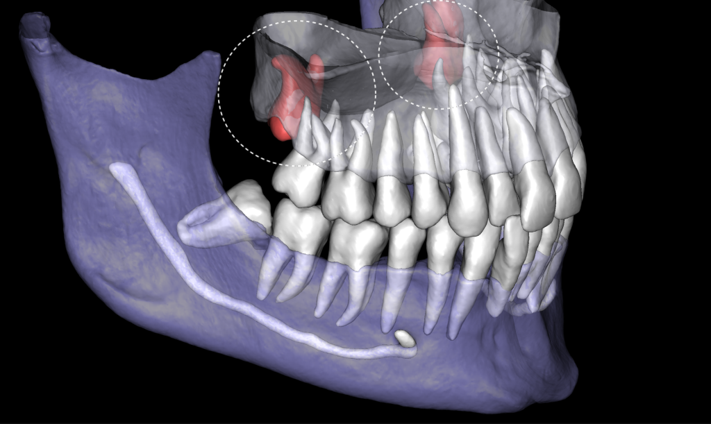 How to carefully plan the third molar extraction? 1
