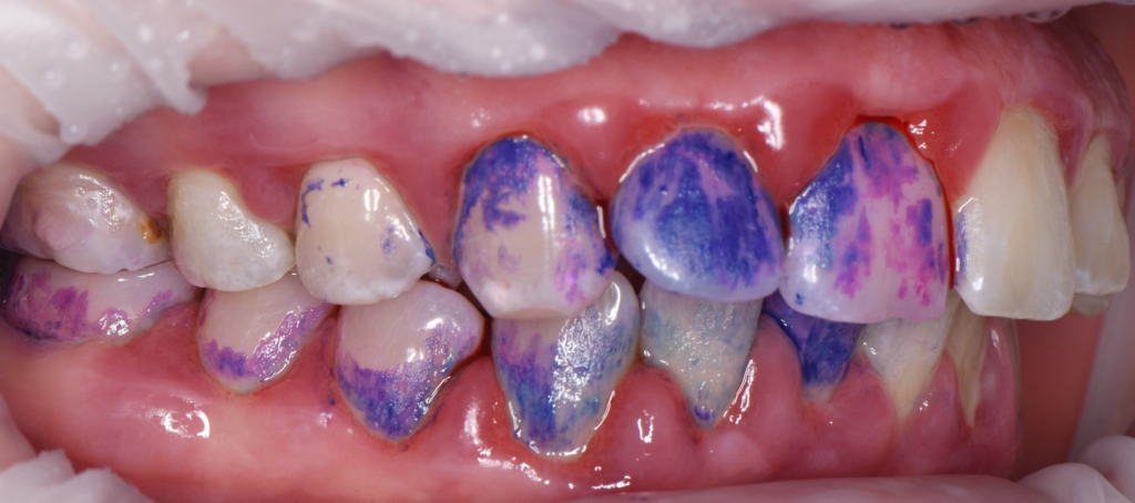 Treatment of severe periodontal disease 3