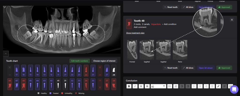 Planning third molar extraction with Diagnocat 3