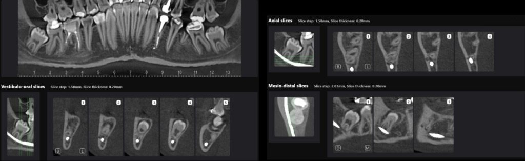 How to carefully plan the third molar extraction? 3