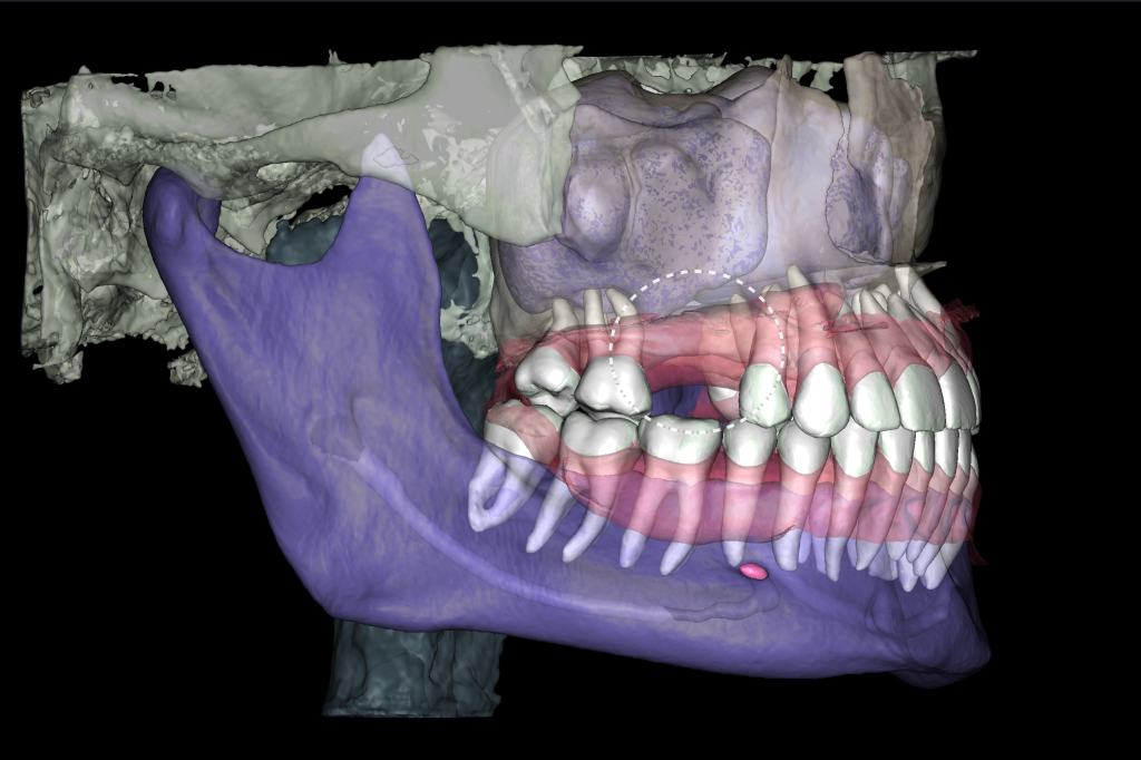Planning guided implant surgery with Diagnocat 5