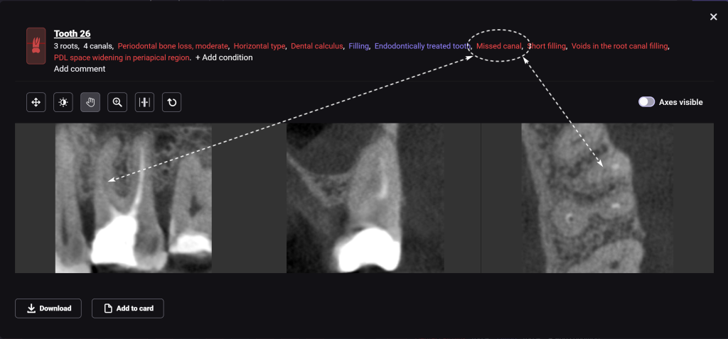 Study root canal morphology and anatomy with Diagnocat 5