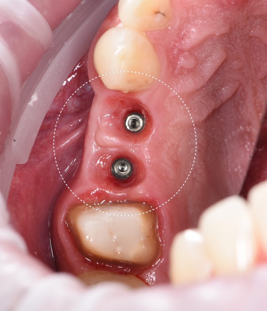 Implantatplanung mit Diagnocat KI 5