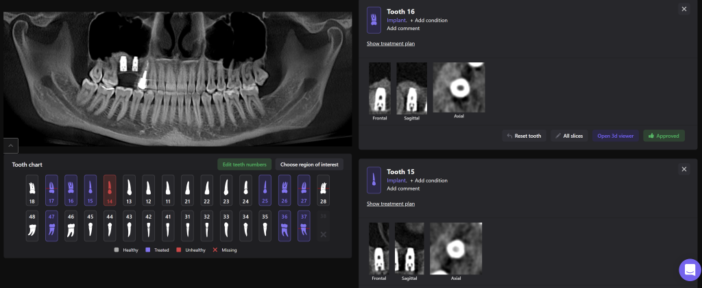 Planning guided implant surgery with Diagnocat 7