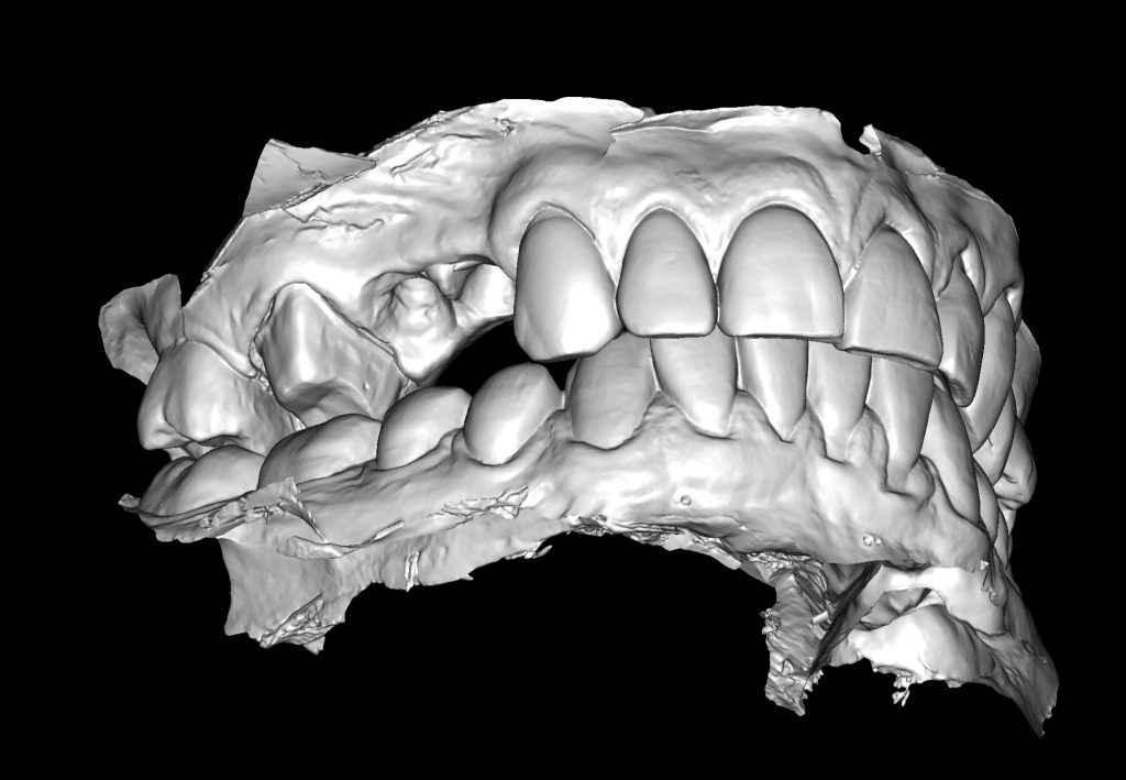 Implantatplanung mit Diagnocat KI 7