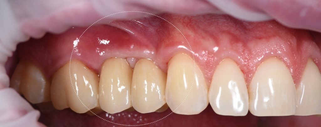 Implantatplanung mit Diagnocat KI 9