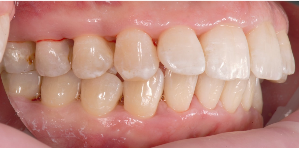 Treatment of severe periodontal disease 13