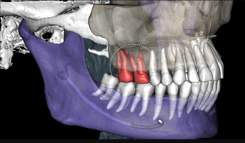 Odontogene Sinusitis mit periapikaler Läsion 1