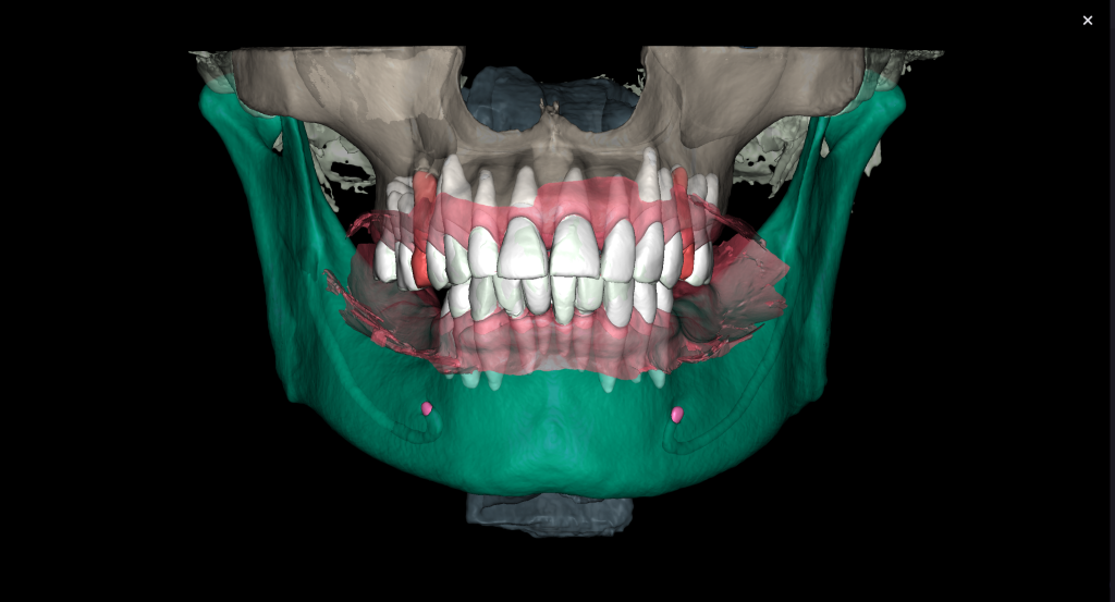 Einfache Implantatplanung mit dem Modul Diagnocat STL 5