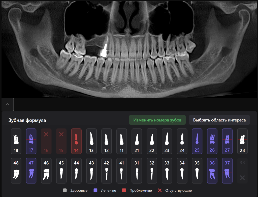 Планирование имплантации с помощью Diagnocat 1