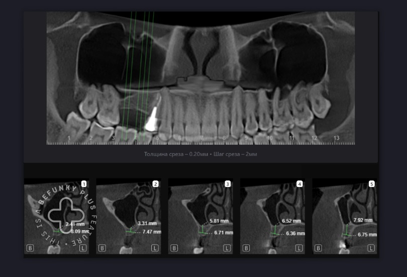 Планирование имплантации с помощью Diagnocat 7