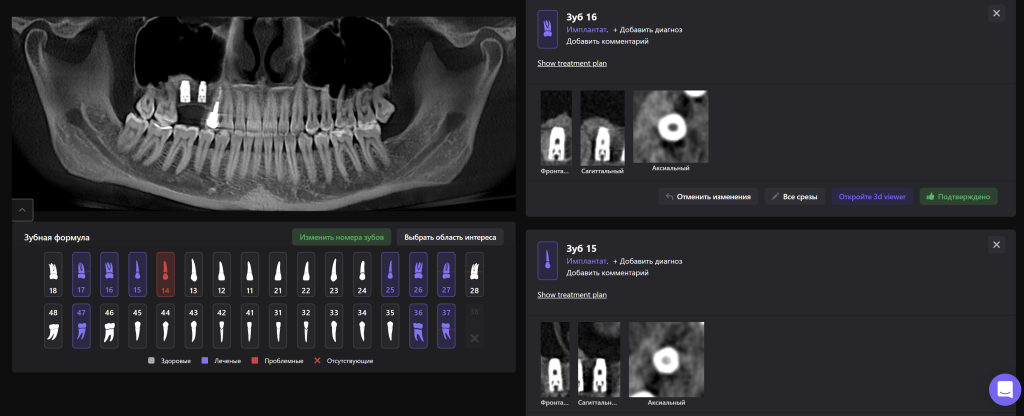 Планирование имплантации с помощью Diagnocat 9